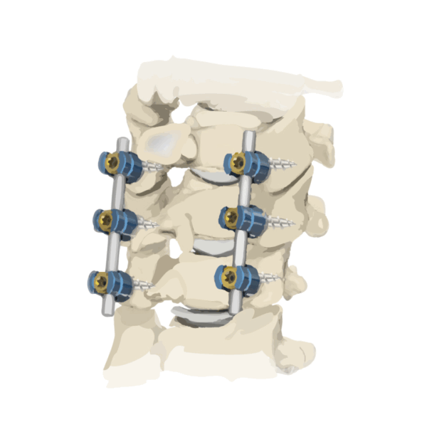 cirugia cervical cirugia cervical